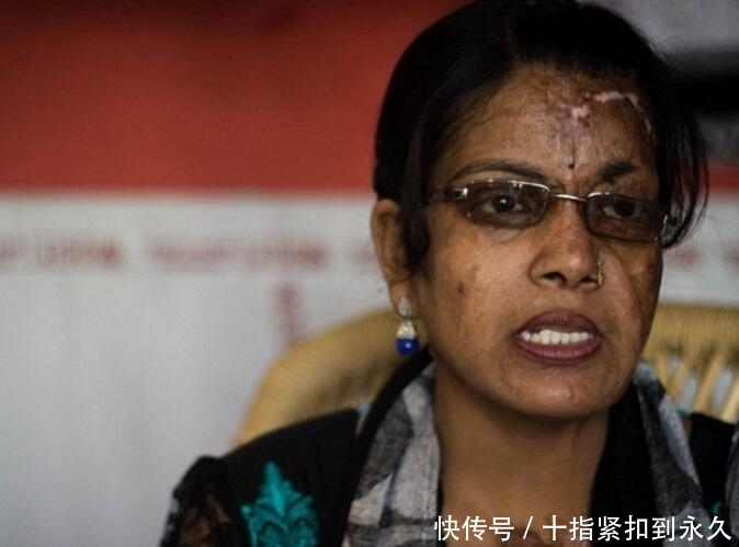 毁容|女孩17岁时因拒绝求婚，被32岁男子泼硫酸毁容