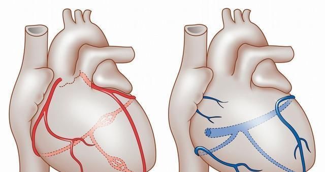 冠心病|冠心病患者有福了,在心脏上架起“桥梁”,能让生命重获“心”生
