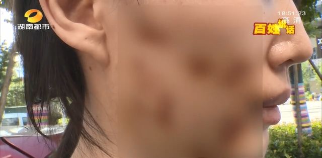  皮肤科连锁|美容变毁容，长沙一女子做超声刀致三度烧伤，出门全靠黑布遮挡