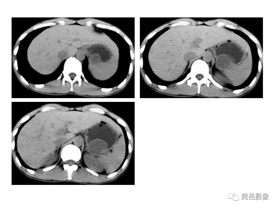 畸形|胃重复畸形CT诊断与鉴别诊断