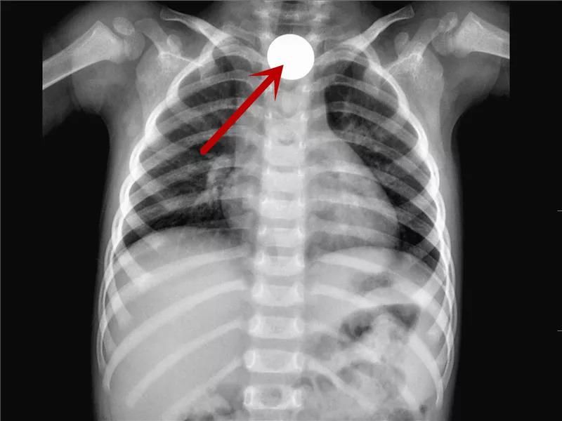  真相|有图有真相：那些年，孩子体内发现的硬币、钥匙、钉子、别针、电池……