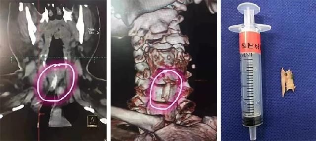  死亡|一根鱼刺，让她离死亡如此之近