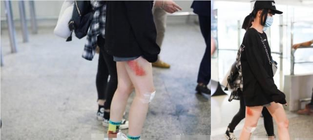 助理|黄龄摔下舞台后首现身,腿部一大片擦伤令人心疼,走路需助理搀扶