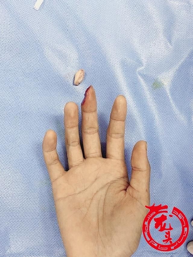  李佳明|女子操作机器不慎手指被切掉松子大一截