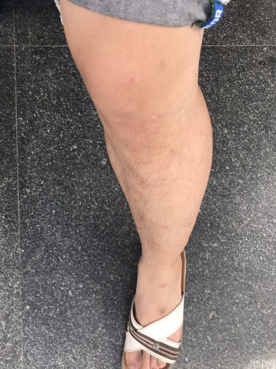  湘湖|杭州小伙去湘湖走了一圈，双腿被咬成这样！最近多人中招