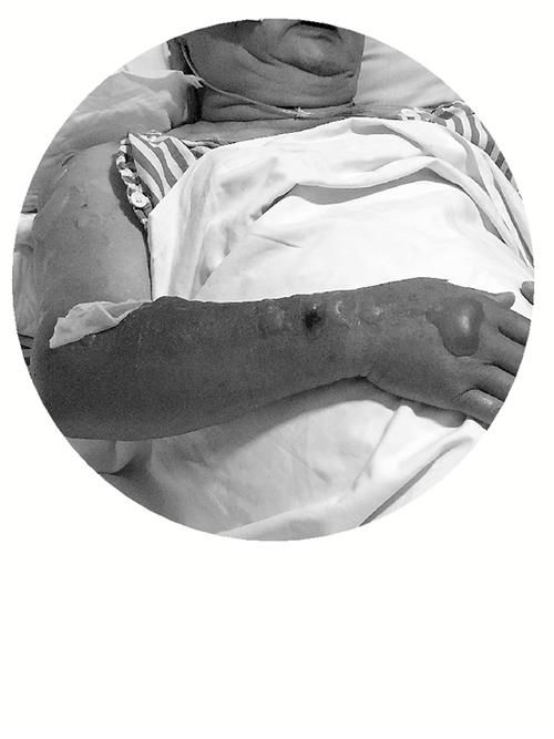  下午|大伯摔了一跤，竟然被路面烫伤同一家医院，一下午接诊3位中暑病人