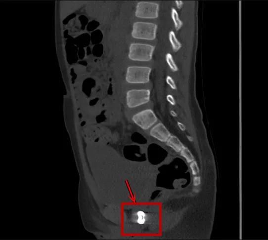  真相|有图有真相：那些年，孩子体内发现的硬币、钥匙、钉子、别针、电池……