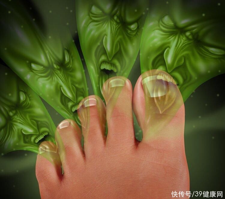 脚气真菌怎么治才能根除(“脚气”真菌怎么治才能根除？教你3个实用方法，根治脚气不复发)
