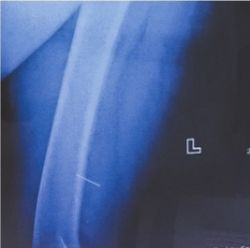  扎进|阿婆莫名腿痛 竟是扎进一根绣花针