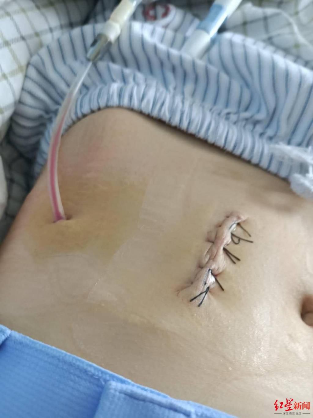  视频中|19岁女孩患尿毒症被生母拉黑，男友陪伴照顾 生母：不是不管，能力只有那么多