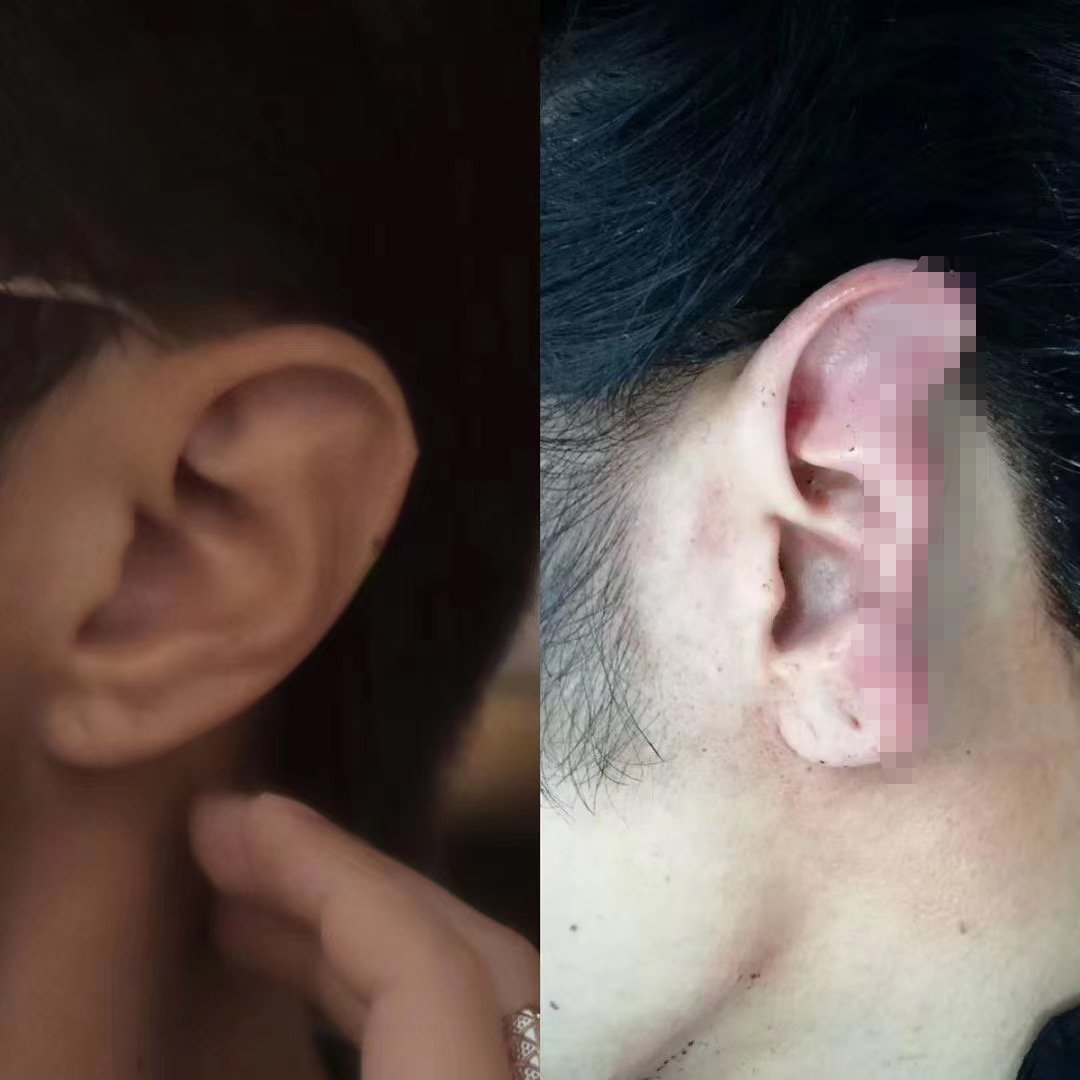  不轨|当街对女孩欲行不轨！沪一小伙上前阻止，被咬掉近半个耳朵…