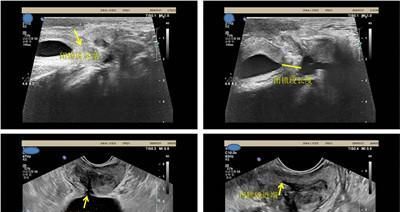  高处|高处坠落致“下水道”爆裂，专家解锁新技能，化解老人难言之隐