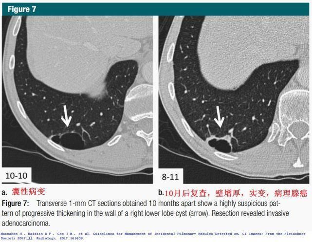 结节|肺结节切还是不切？20张经典图谱说明白了！