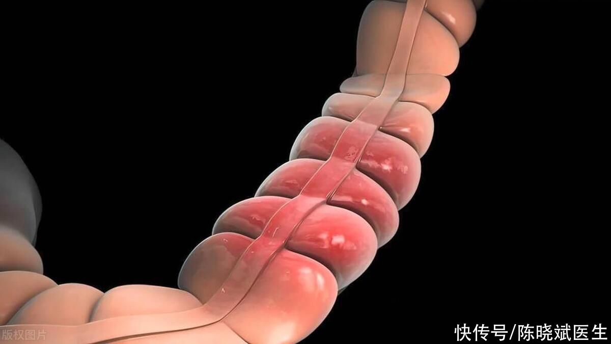 如何阻断肠息肉转变成肠癌之路(医生忠告：肠息肉不想变肠癌，4种东西尽量少吃，再馋也要忍住)