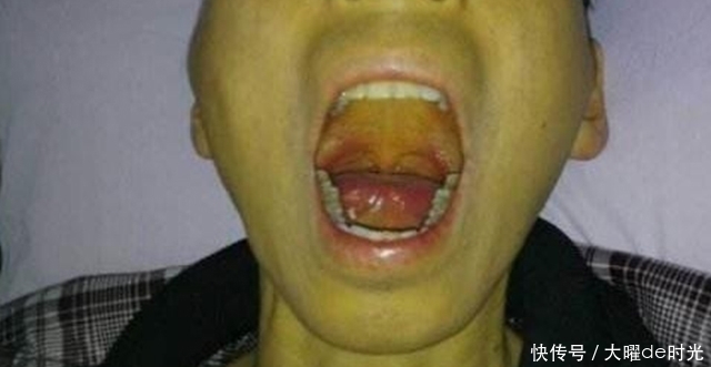 不好|肝不好的人,有5个表现,小心肝硬化,常吃一水果,预防肝癌