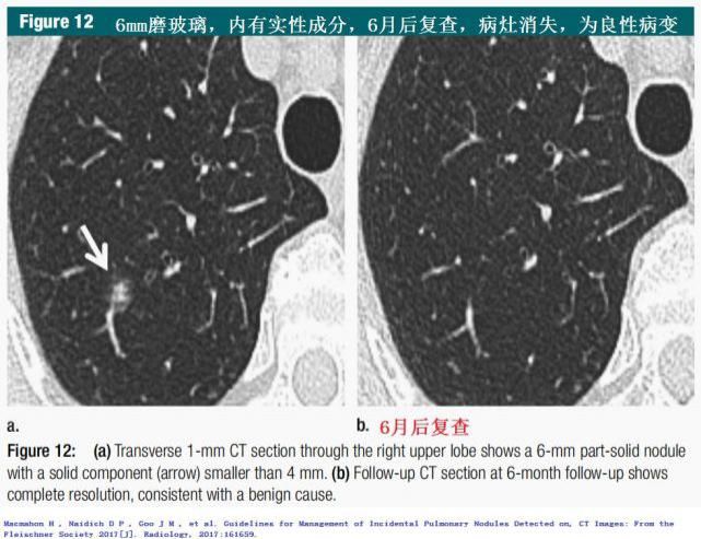  结节|肺结节切还是不切？20张经典图谱说明白了！