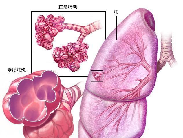  肺气肿患者|肺气肿不注意，3大并发症让人头疼，3个解决办法