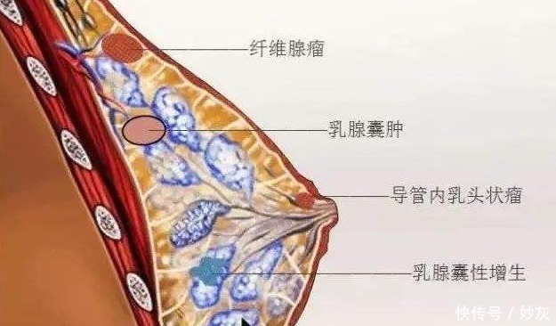  王女士|粉红乳丹消结卫士提醒：得了乳腺结节，千万别乱治！