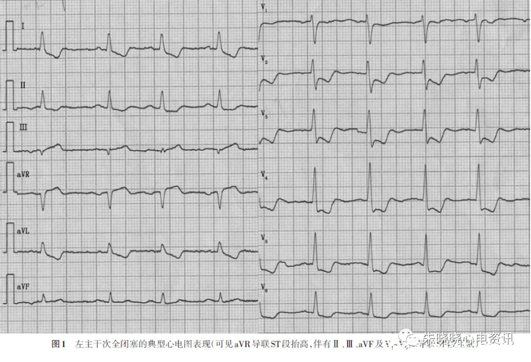 冠状动脉|左主干闭塞的心电图表现