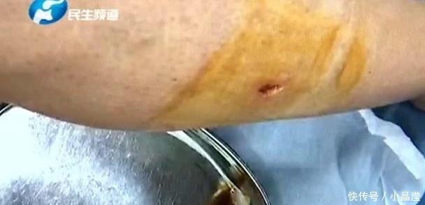  付女士|女子遛狗不栓绳被咬伤，上门索赔1万5，邻居：没拴绳就是你的错