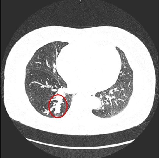  深圳|深圳女子咳嗽一年多，吃药没用！一照CT，医生懵了……